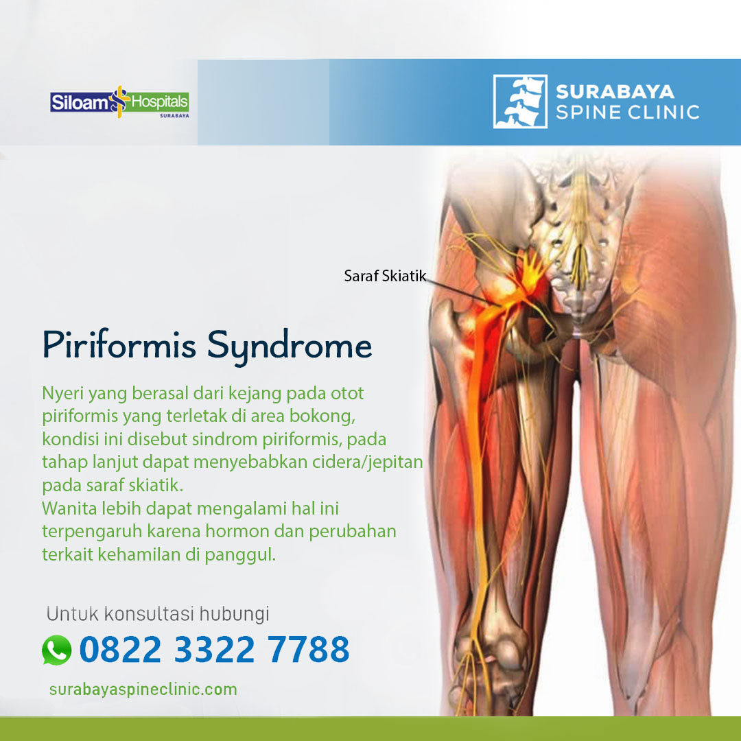 Sindrom Piriformis 